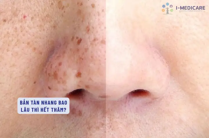 Cách Làm Hết Tàn Nhang Nhanh Nhất Tại Nhà