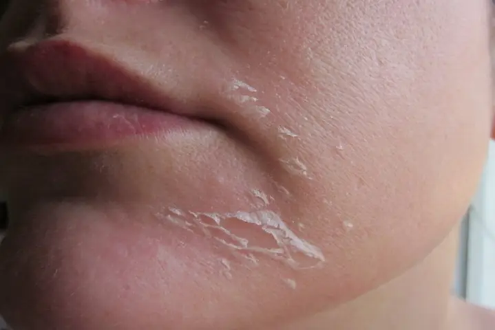 Cách Làm Hết Tróc Da Mặt