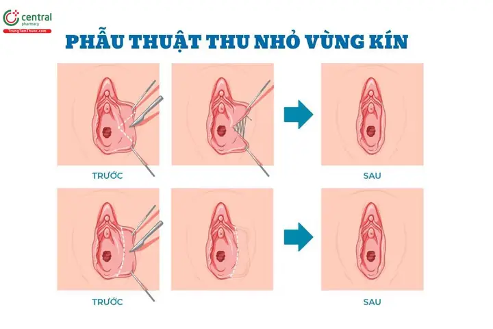 Cách Làm Khít Bím Tại Nhà