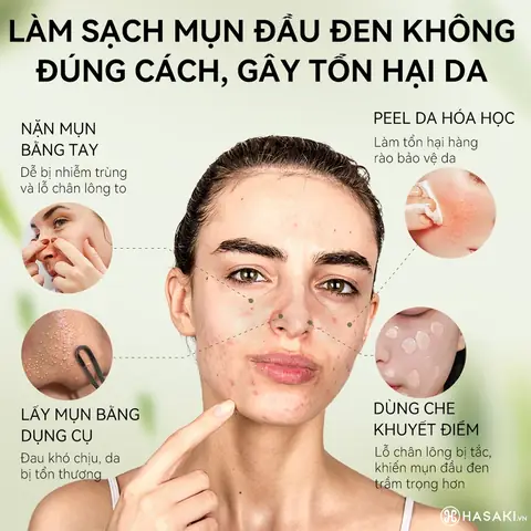Cách Làm Mặt Nạ Lột Mụn Bằng Keo Sữa