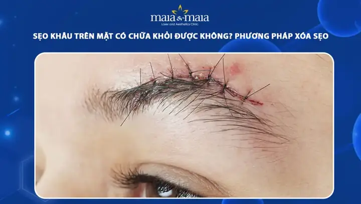 Cách Làm Mờ Sẹo Ở Mặt