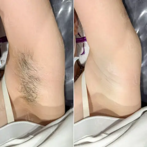 Cách Làm Sạch Lông Nách Tuổi Dậy Thì