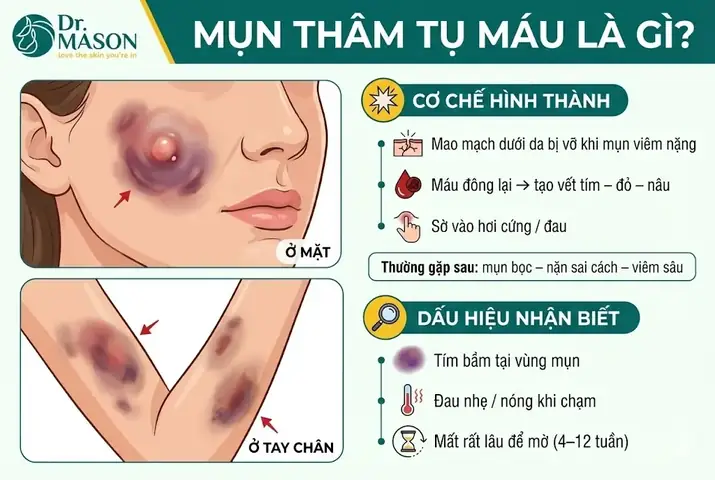 Cách Làm Tan Máu Bầm Mụn