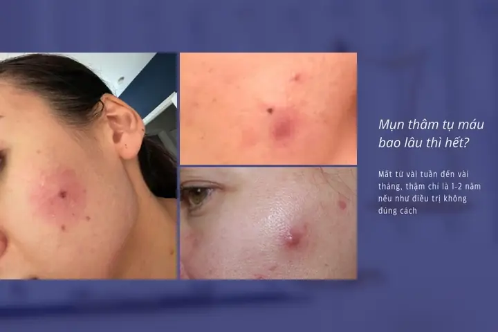 Cách Làm Tan Máu Bầm Mụn