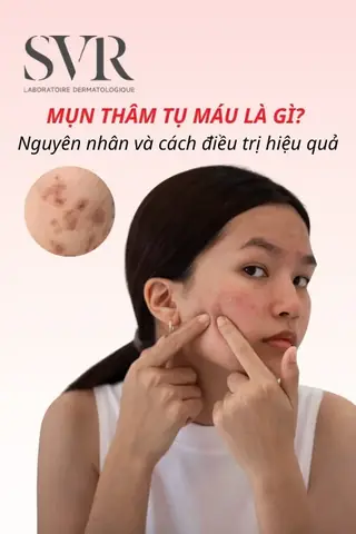 Cách Làm Tan Máu Bầm Mụn