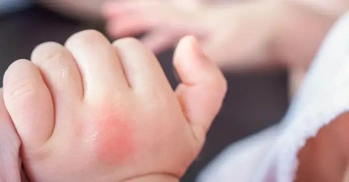 Cách Làm Tịt Nốt Muỗi Đốt Ở Trẻ Sơ Sinh