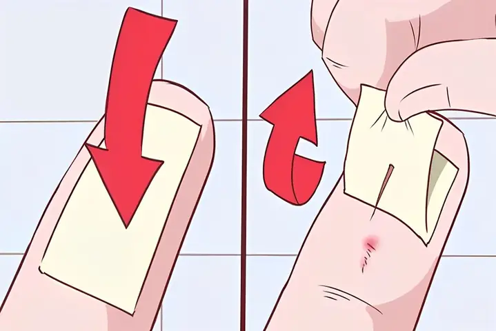 Cách Lấy Dằm Đâm Sâu Vào Chân