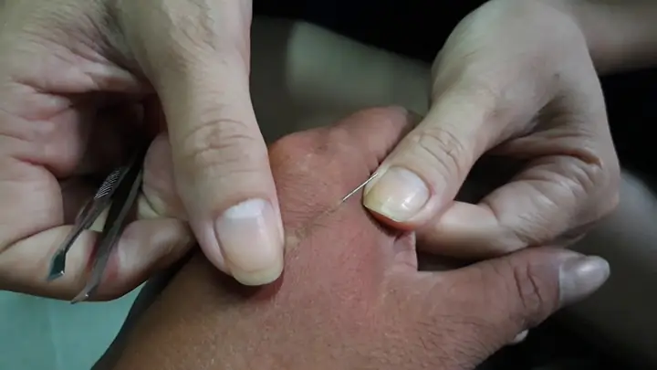 Cách Lấy Dằm Ở Lòng Bàn Tay