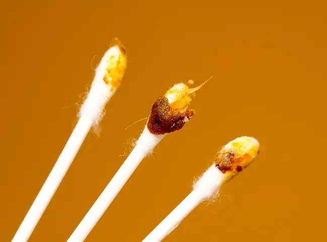 Cách Lấy Ráy Tai Hiệu Quả