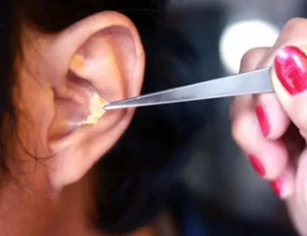 Cách Lấy Ráy Tai Hiệu Quả