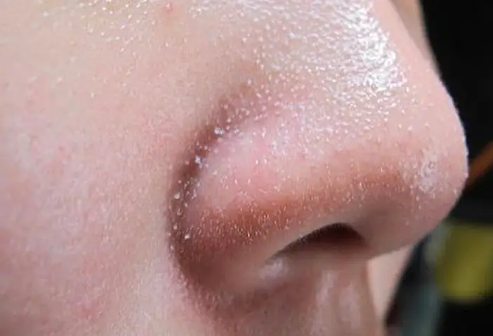 Cách Lột Mụn Cám Hiệu Quả Nhất