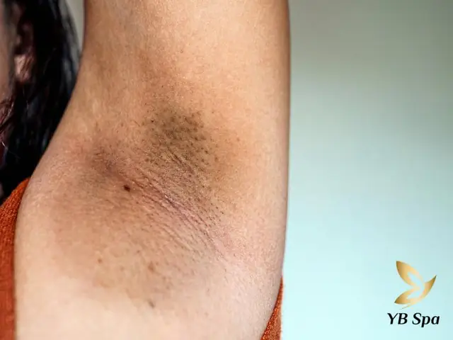 Cách Nhổ Lông Nách Không Đau Không Thâm