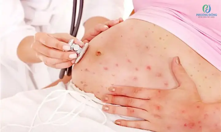 Cách Phòng Tránh Thủy Đậu Cho Bà Bầu