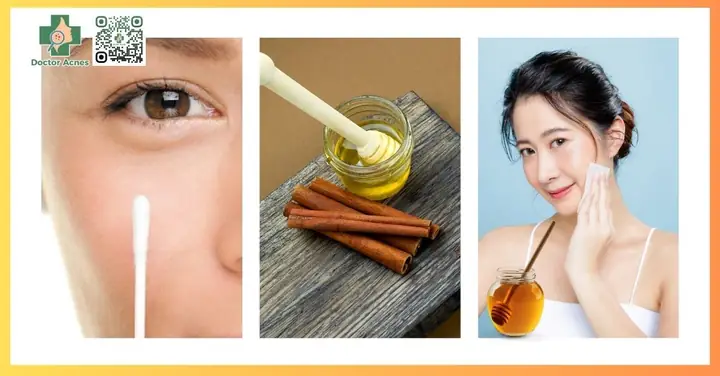 Cách Sử Dụng Mật Ong Trị Mụn