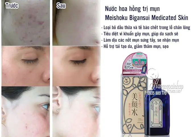 Cách Sử Dụng Nước Hoa Hồng Trị Mụn Nhật Bản