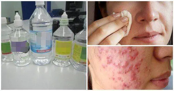 Cách Sử Dụng Nước Muối Sinh Lý Để Rửa Mặt