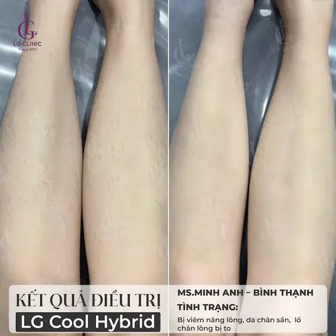 Cách Tẩy Lông Chân Cho Nữ