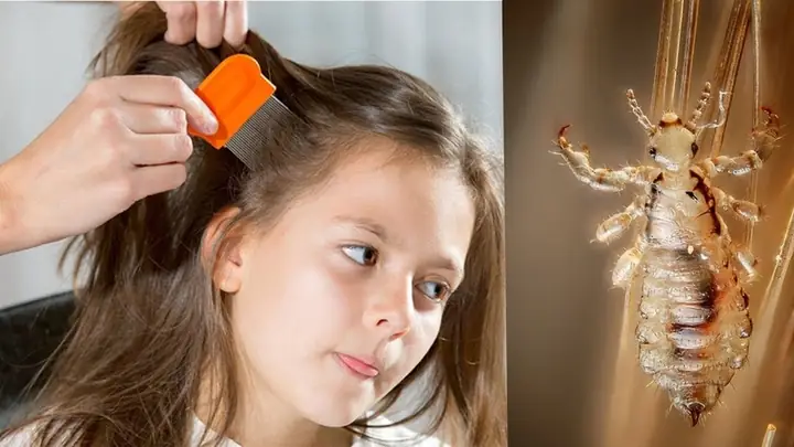 Cách Trị Chấy Bằng Muối Hột