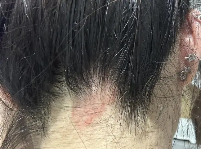 Cách Trị Dị Ứng Da Đầu