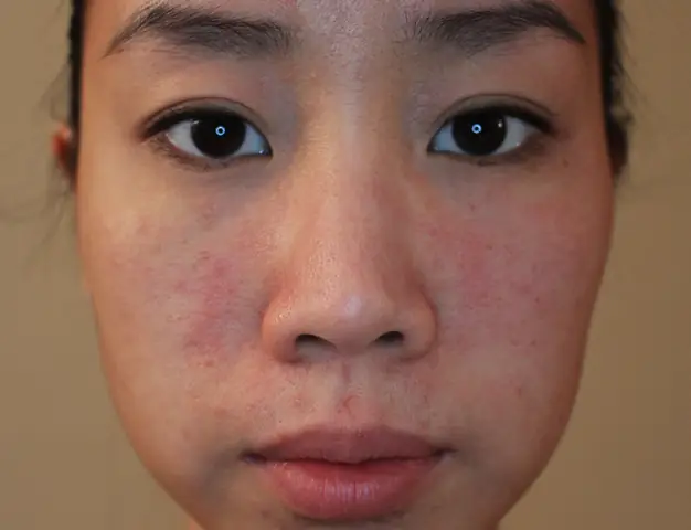 Cách Trị Dị Ứng Da Đầu