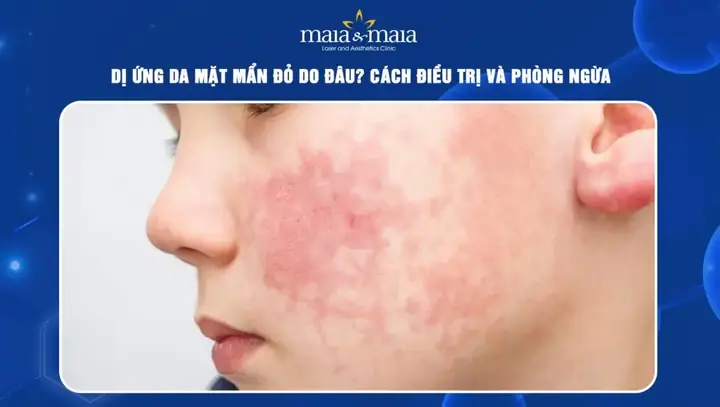 Cách Trị Dị Ứng Da Đầu