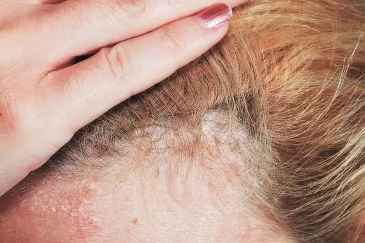 Cách Trị Dị Ứng Da Đầu