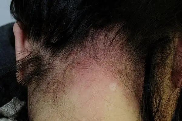 Cách Trị Dị Ứng Da Đầu