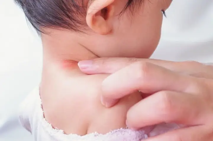 Cách Trị Hâm Cổ Cho Bé