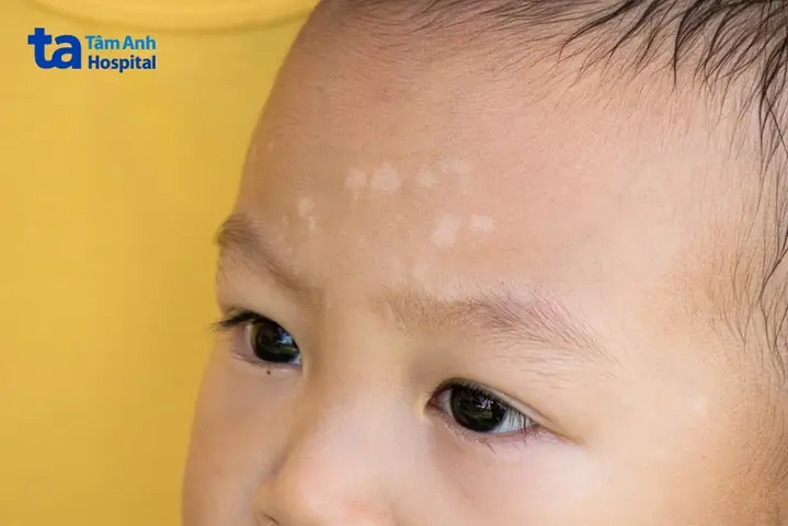 Cách Trị Lang Beng Cho Tre So Sinh