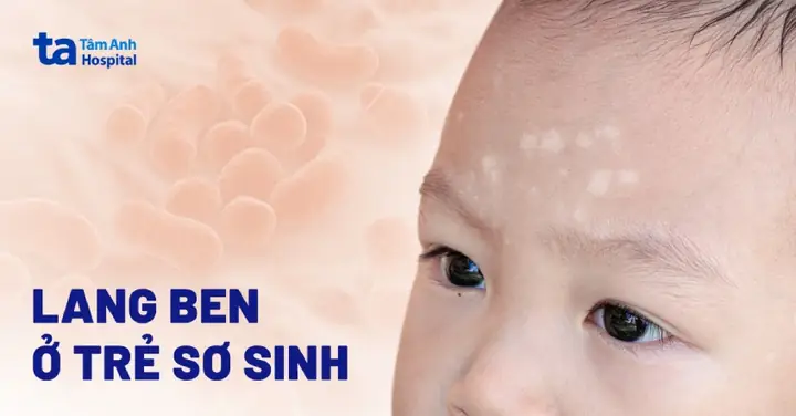 Cách Trị Lang Beng Cho Tre So Sinh Cách Trị Lang Beng Cho Tre So Sinh