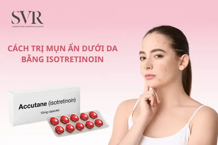 Cách Trị Mụn An Dưới Da Bằng Thiên Nhiên