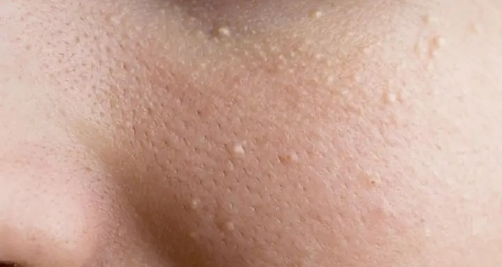 Cách Trị Mụn An Dưới Da Bằng Thiên Nhiên