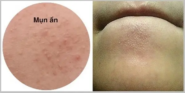 Cách Trị Mụn An Dưới Da Bằng Thiên Nhiên