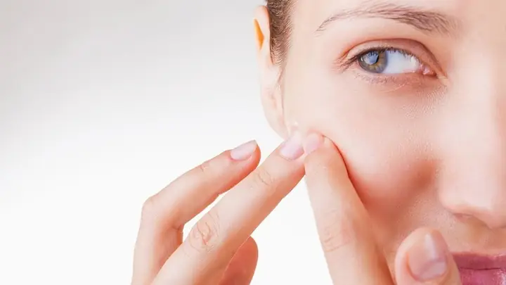 Cách Trị Mụn An Dưới Da Bằng Thiên Nhiên