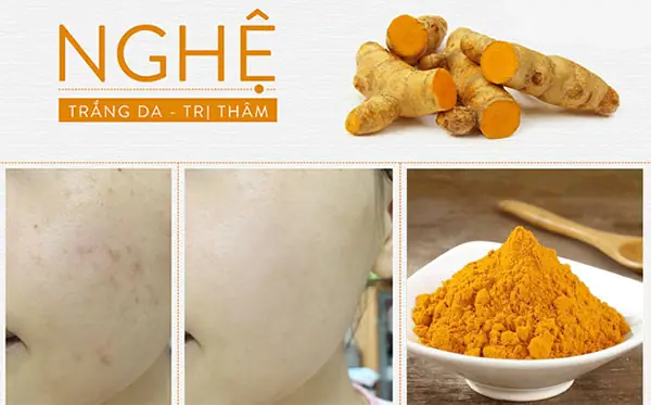 Cách Trị Mụn Bằng Bột Nghệ Và Sữa Chua