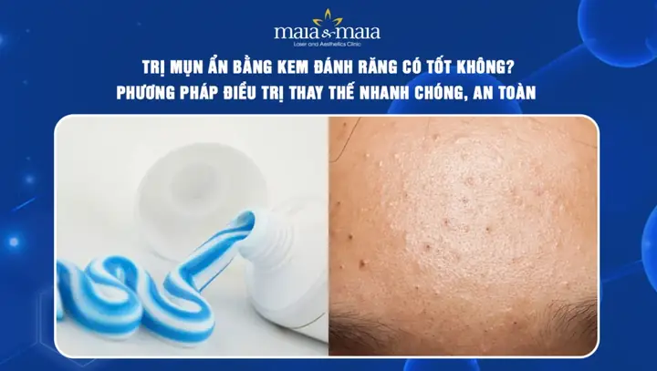 Cách Trị Mụn Bằng Muối Và Kem Đánh Răng