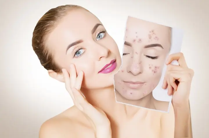 Cách Trị Mụn Bằng Phấn Rôm