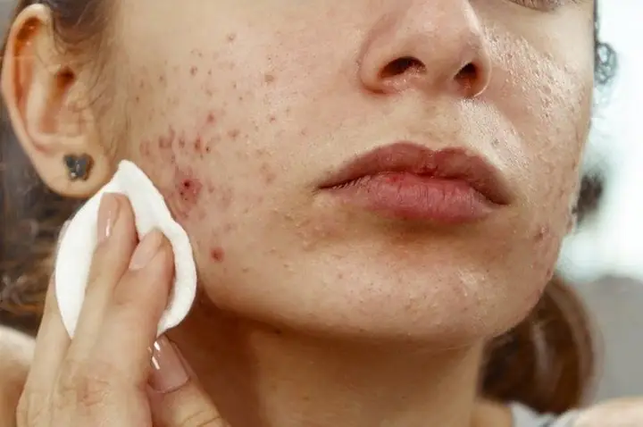 Cách Trị Mụn Bằng Thuốc Bắc