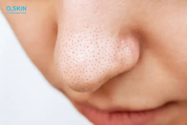 Cách Trị Mụn Đầu Đen Bằng Kem Đánh Răng