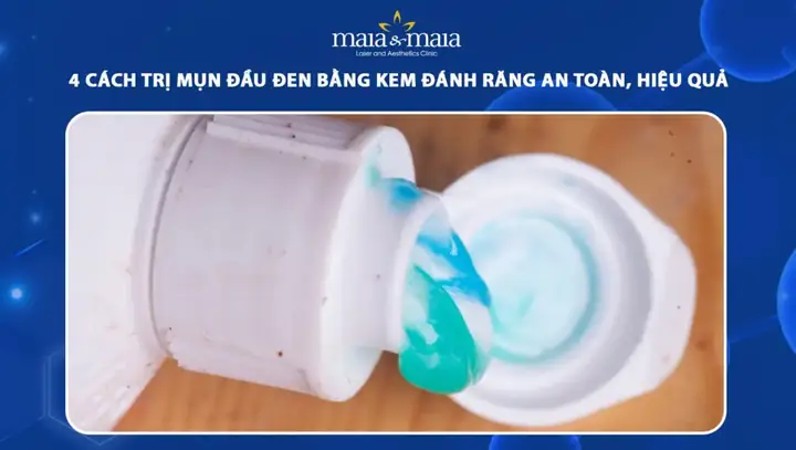 Cách Trị Mụn Đầu Đen Bằng Kem Đánh Răng