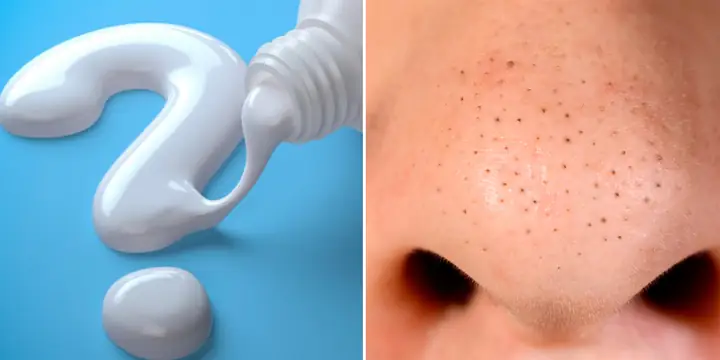 Cách Trị Mụn Đầu Đen Bằng Kem Đánh Răng