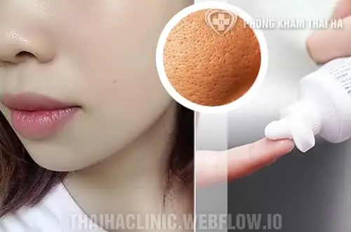 Cách Trị Mụn Đầu Đen Bằng Kem Đánh Răng