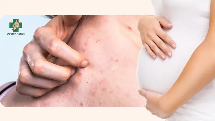 Cách Trị Mụn Ở Bà Bầu