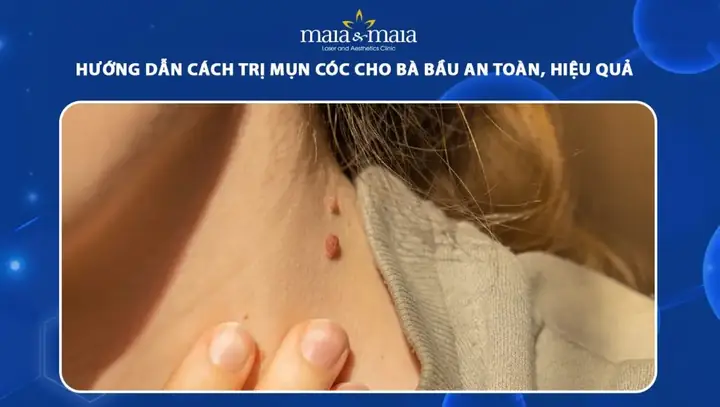 Cách Trị Mụn Ở Bà Bầu