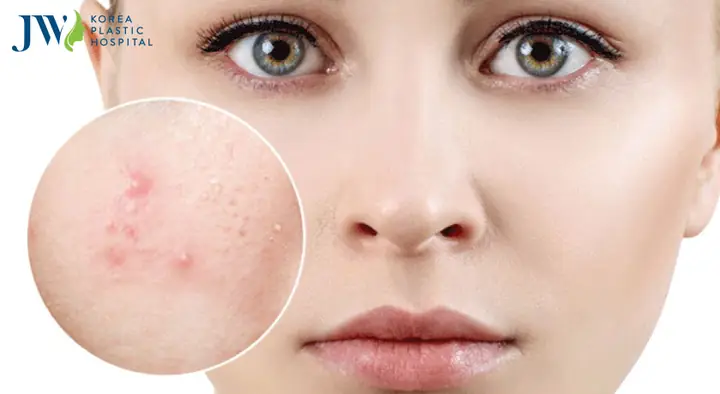 Cách Trị Mụn Tại Nhà Bằng Mật Ong