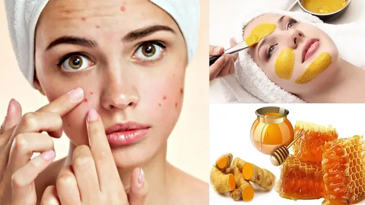 Cách Trị Mụn Tại Nhà Bằng Mật Ong