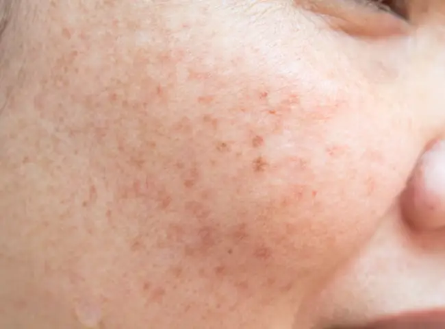 Cách Trị Mụn Thâm Trên Mặt