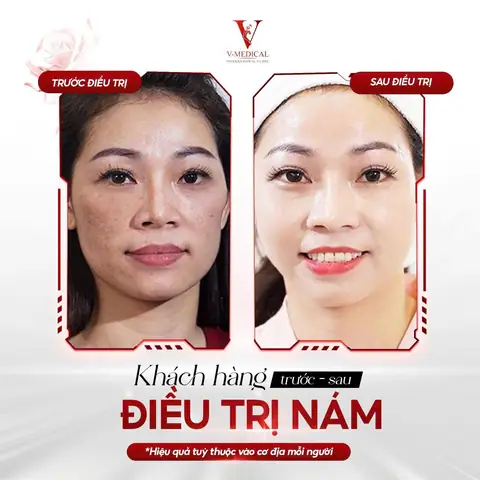 Cách Trị Nám Bằng Quả Gấc