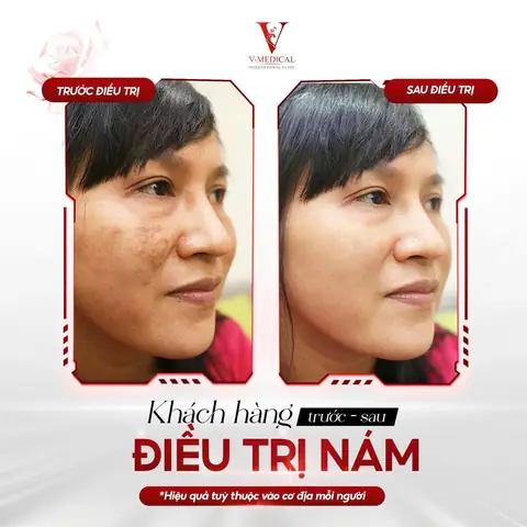 Cách Trị Nám Bằng Quả Gấc