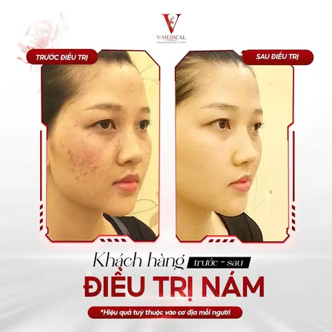 Cách Trị Nám Bằng Quả Gấc